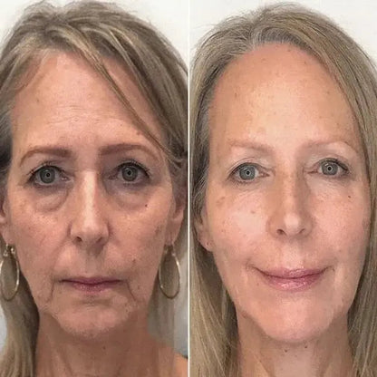 SkinLift™ Botox Serum - Synligt yngre hud på 14 dage.
